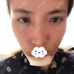 森碟下巴后縮改善了很多